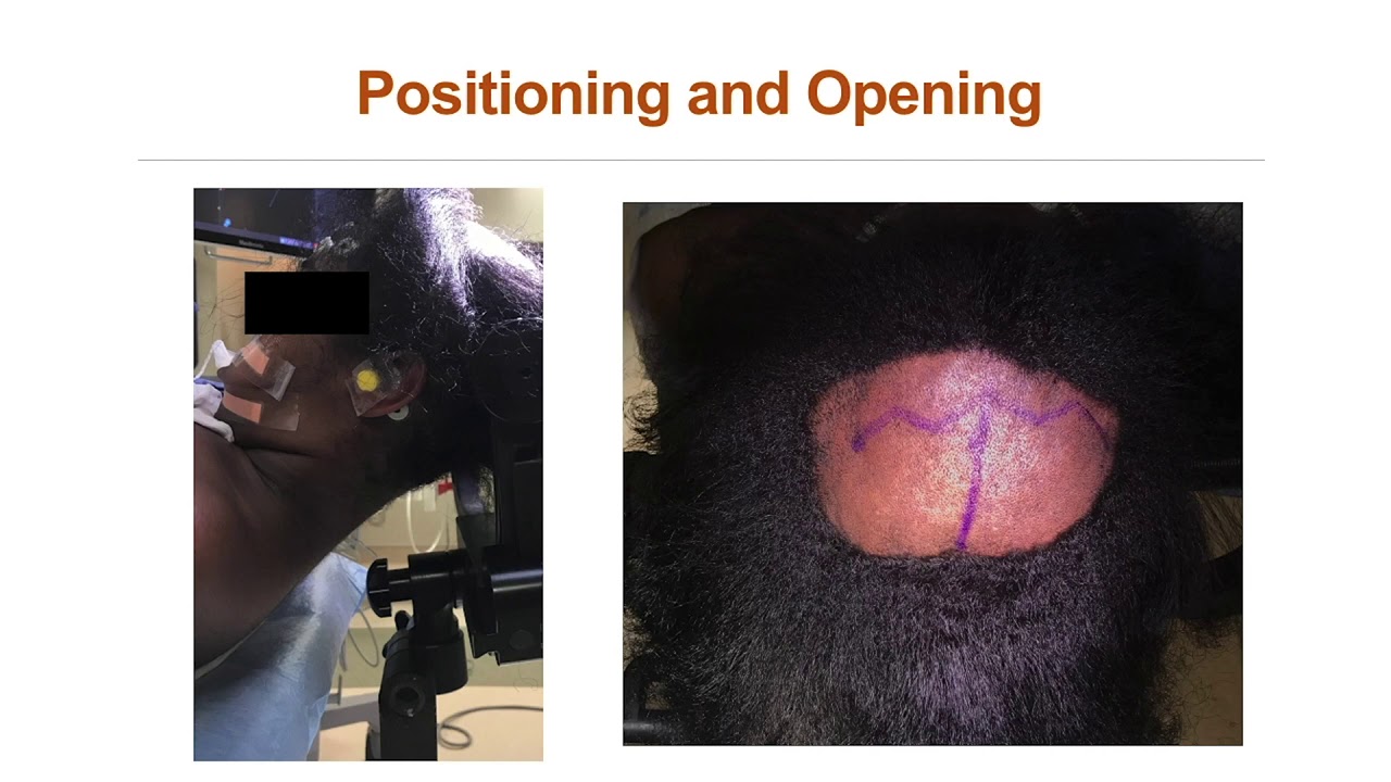 Posterior transcallosal intervenous-interforniceal approach to a periaqueductal tumor