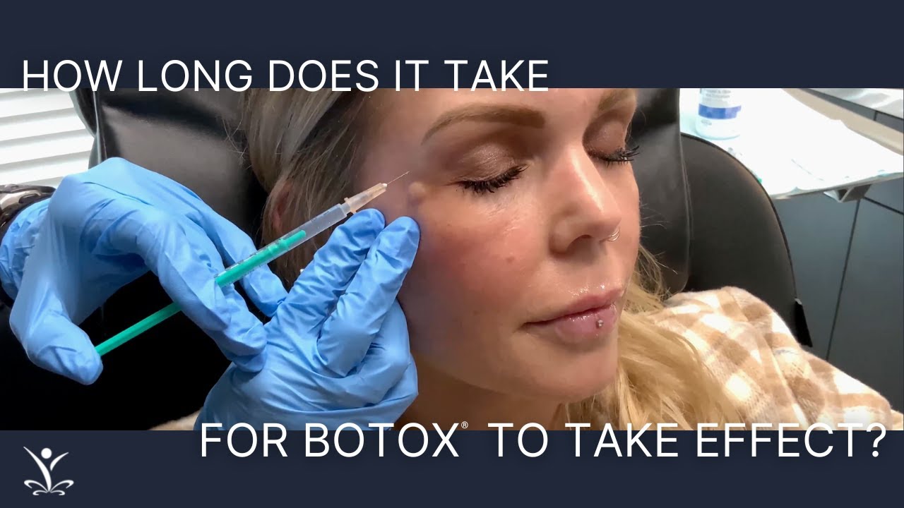 Botox for Crow’s Feet & Forehead