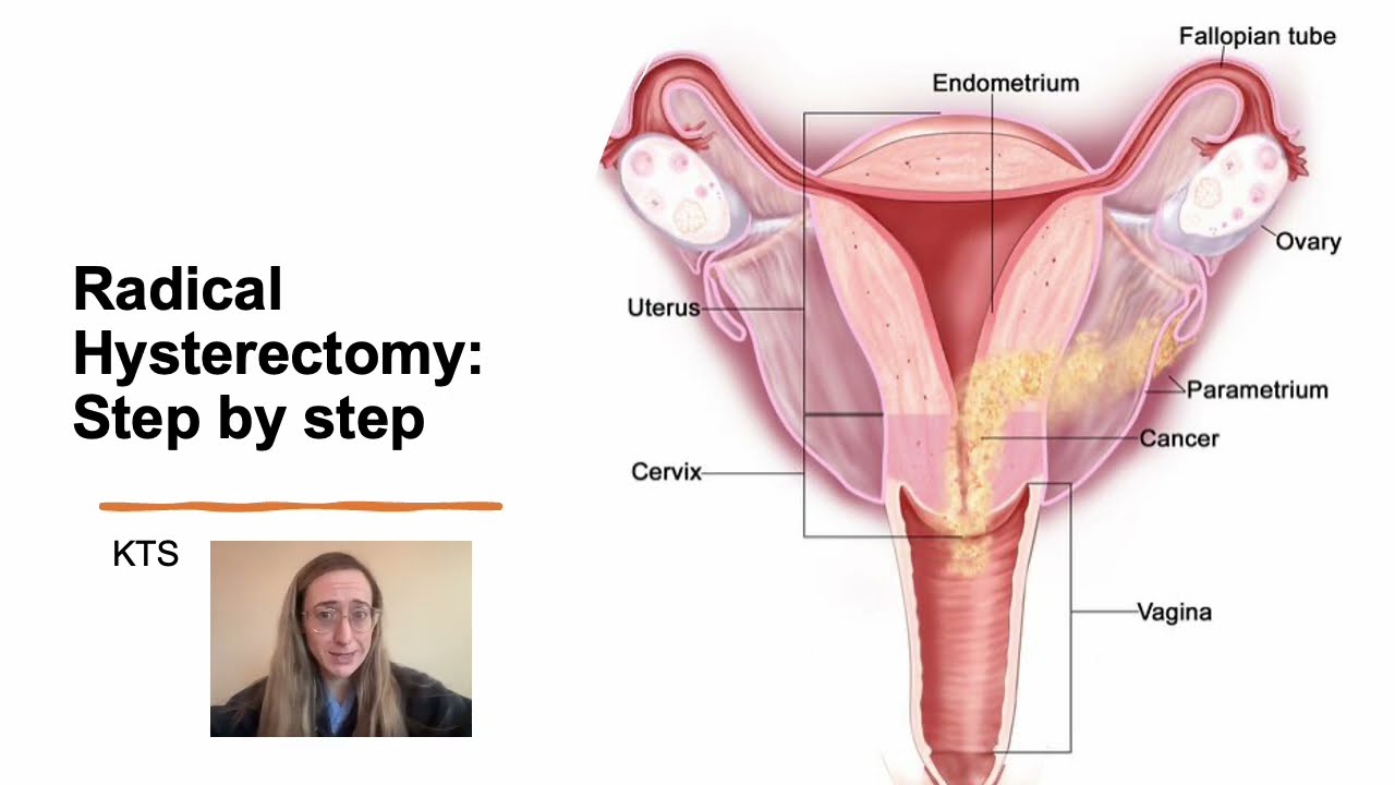 Radical Hysterectomy Step by Step