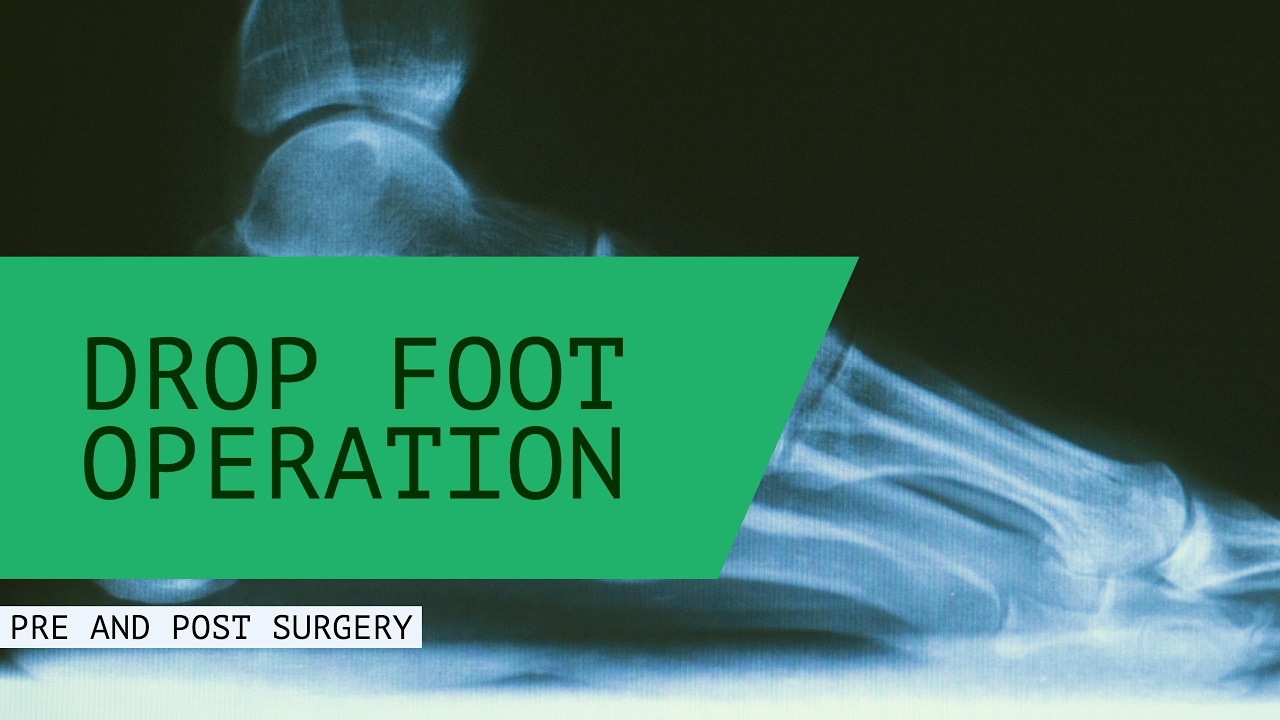 Drop Foot Operation Pre and Post Surgery Testimonial