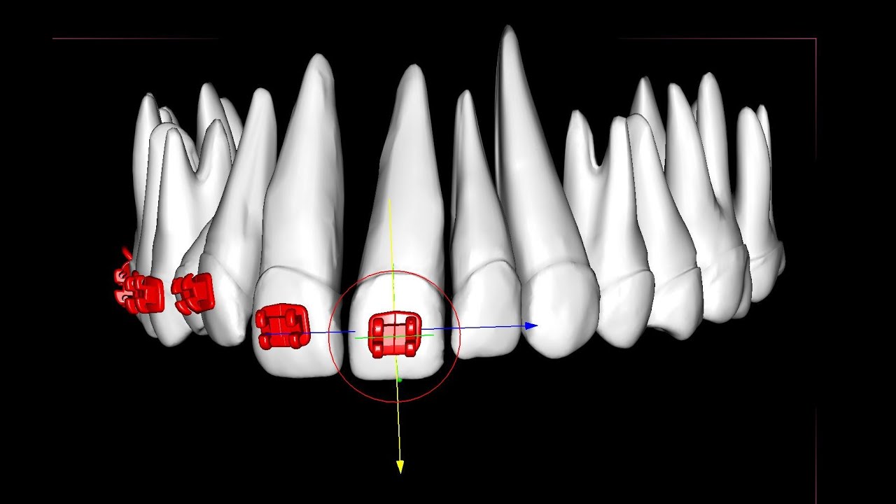 Placing orthodontic brackets on central incisors