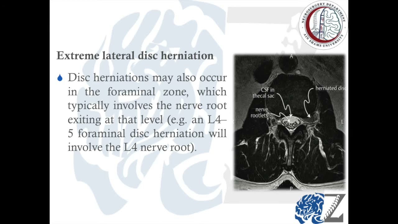Degenerative Spine (6):  Lumbar Disc Prolapse : الانزلاق الغضروفي القطني