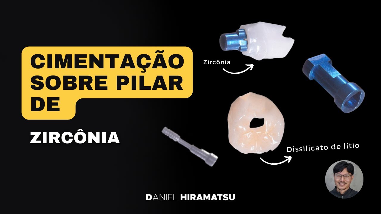 Cimentação sobre pilar de zircônia