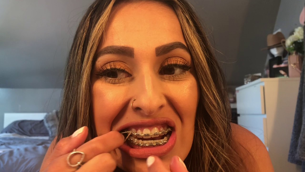 BRACES UPDATE - ELASTICS