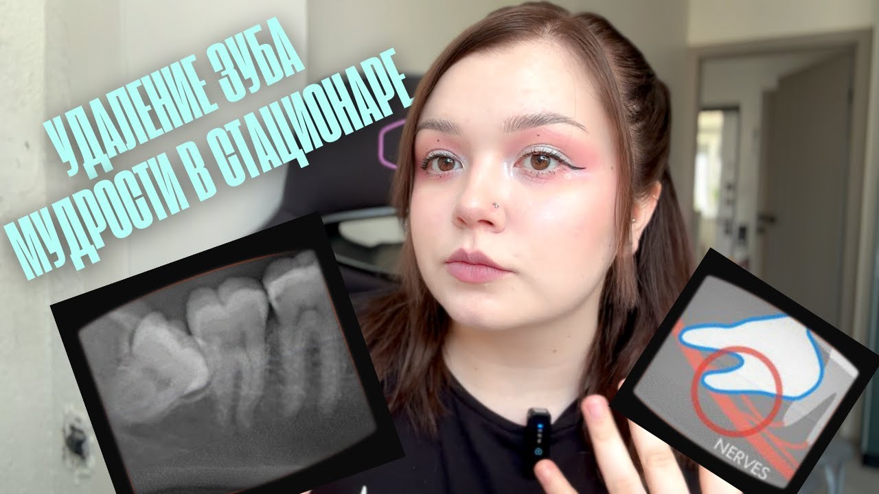 Удаление зуба мудрости в стационаре: мой опыт в больнице + макияж