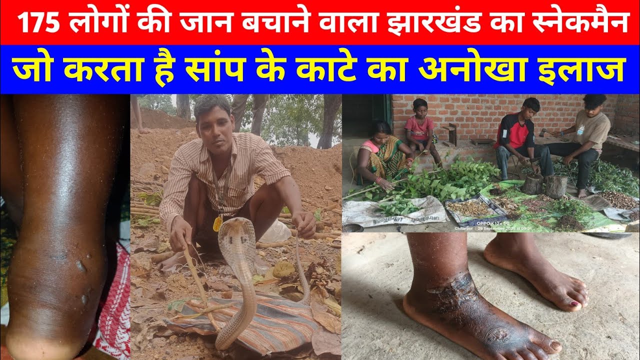 झारखंड के स्नेक मैन का अनोखा इलाज! #snake #news #jharkhand #india