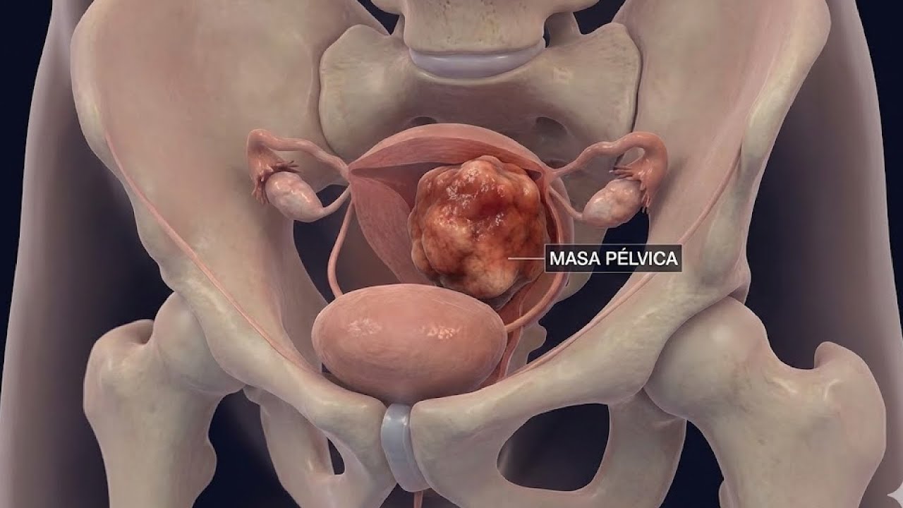 De la masa pélvica al tumor de ovario - Dra. Lina Figueira