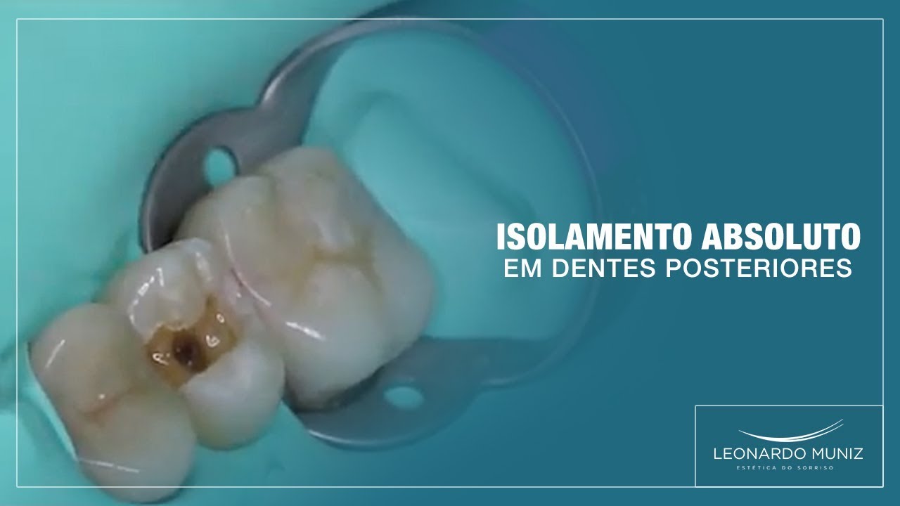 Isolamento Absoluto em Dentes Posteriores | Leonardo Muniz