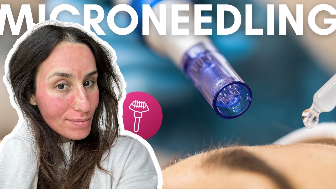 J'ai testé le microneedling : rides atténués ? Pores resserrés ?