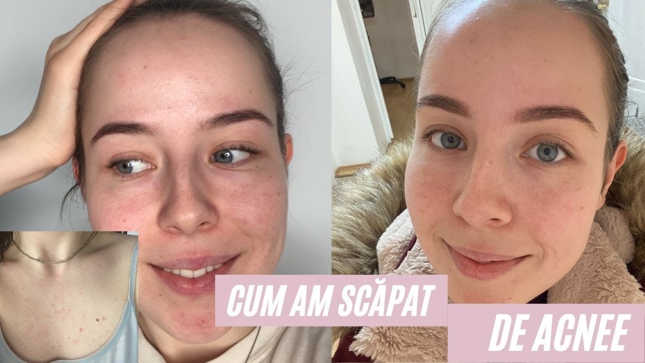 Cum am scăpat de ACNEE/ COȘURI