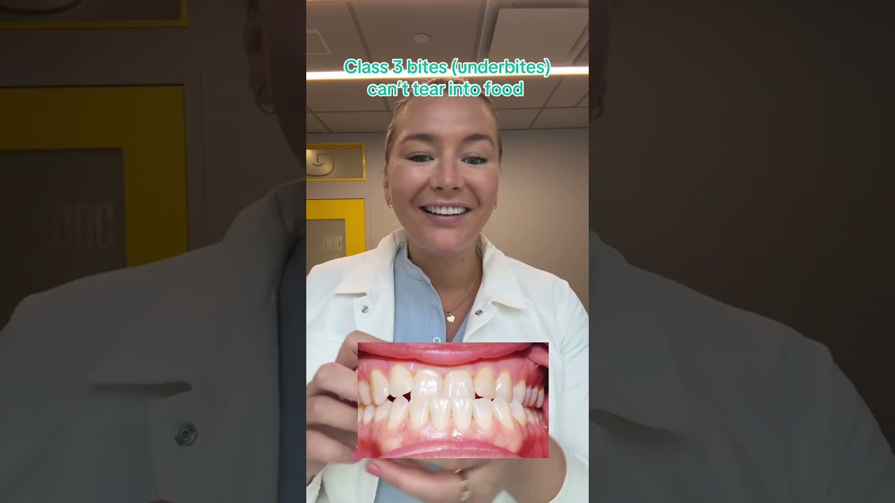 This is how to fix underbites! If you have a skeletal underbite the only way to fix it is with surge