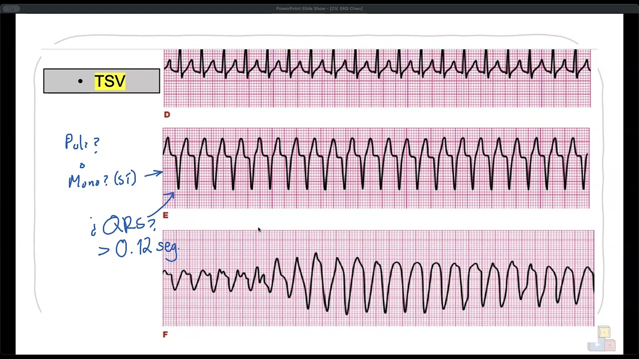 ID arritmias, mini ejercicios ECG