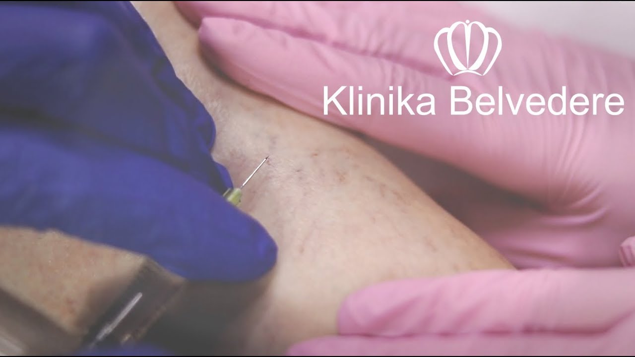 Usuwanie pajączków na nogach - mikroskleroterapia, skleroterapia kompresyjna (Klinika Belvedere)