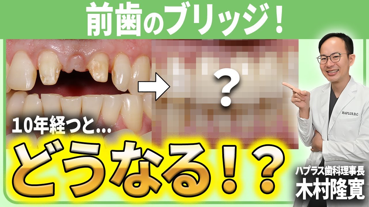 歯のブリッジは長期間経つとどう変化するのか？歯周病も含んだ症例を現役歯科医師がご紹介させていただきます