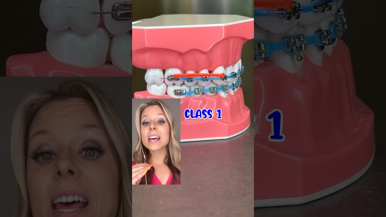 RUBBER BAND PATTERNS EXPLAINED BY AN ORTHODONTIST 🦷 HOW BRACES WORK EXPLANATION