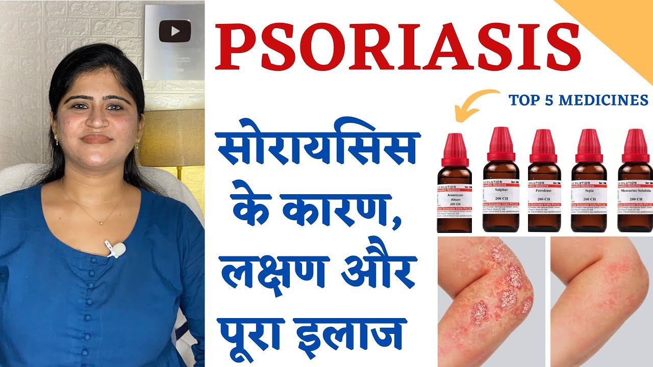 Psoriasis Homeopathic Treatment ॥ सोरायसिस के कारण, लक्षण और पूरा इलाज॥ Top 5 Homeopathic Medicines