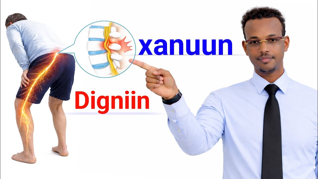 Neerfa xanuunka dhabarka qeeybta hoose ilaa lugta iyo fitamiin B1 Marka uu........................