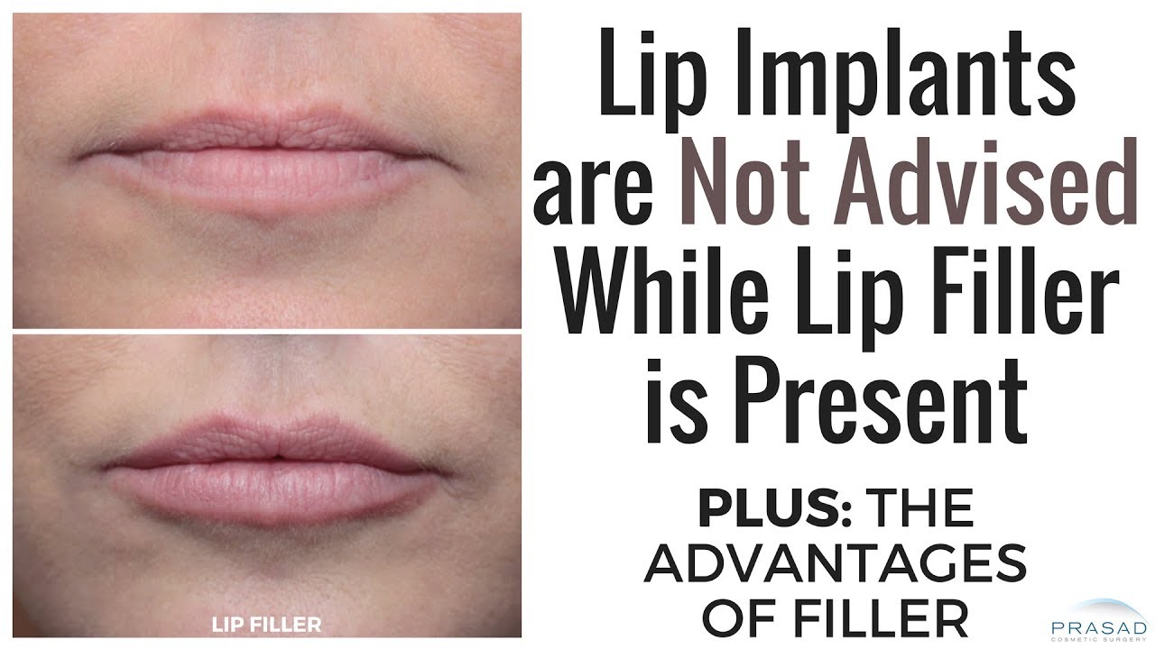 Why Lip Filler Should be Gone Before Considering a Lip Implant, and the Advantages of Fillers