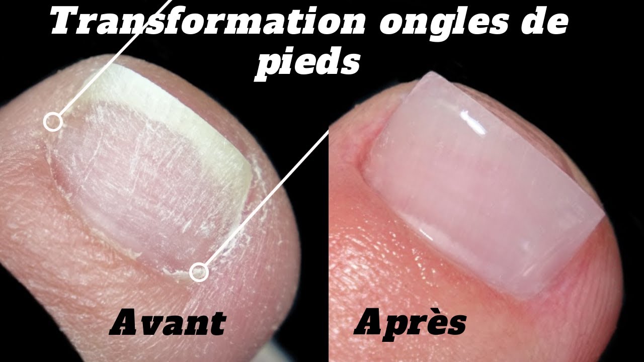 Transformation d'ongles / Correction Ongles De Pieds / Pédicure cosmétique / Roses on the nails