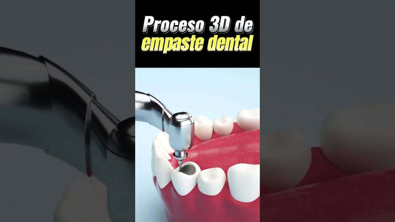 &iquest;Es necesario un empaste si la caries es peque&ntilde;a?