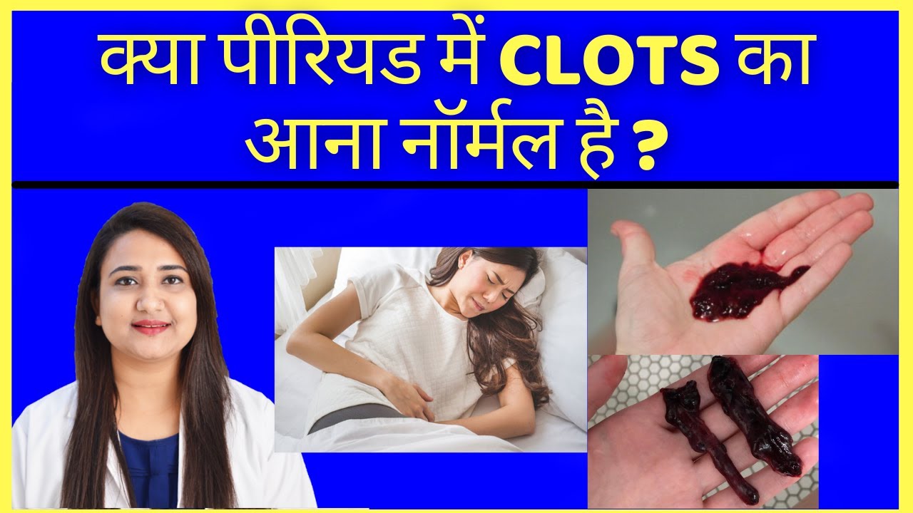 क्या पीरियड में CLOTS का आना नॉर्मल है ?