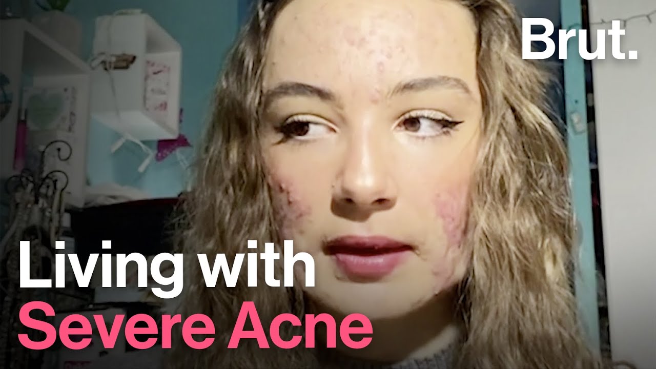 Living with Severe Acne: Mattéa Tells Her Story