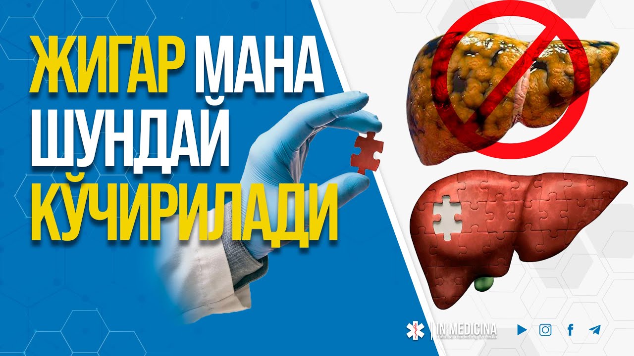 Жигарни кўчириш амалиёти (2024). #inmedicina #jarrohlik #jigar