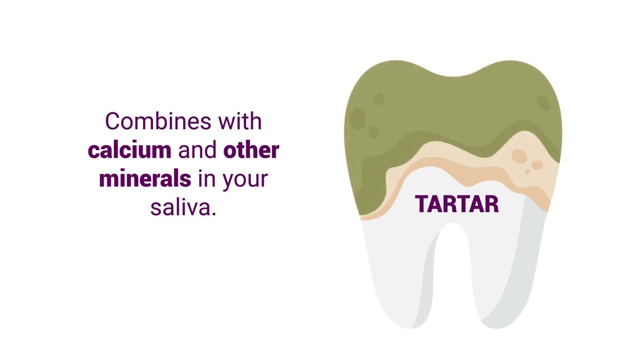 Plaque vs Tartar