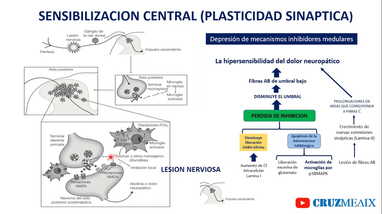 Fisiopatología del dolor parte 02: Sensibilización periférica y central. Dolor Neuropático