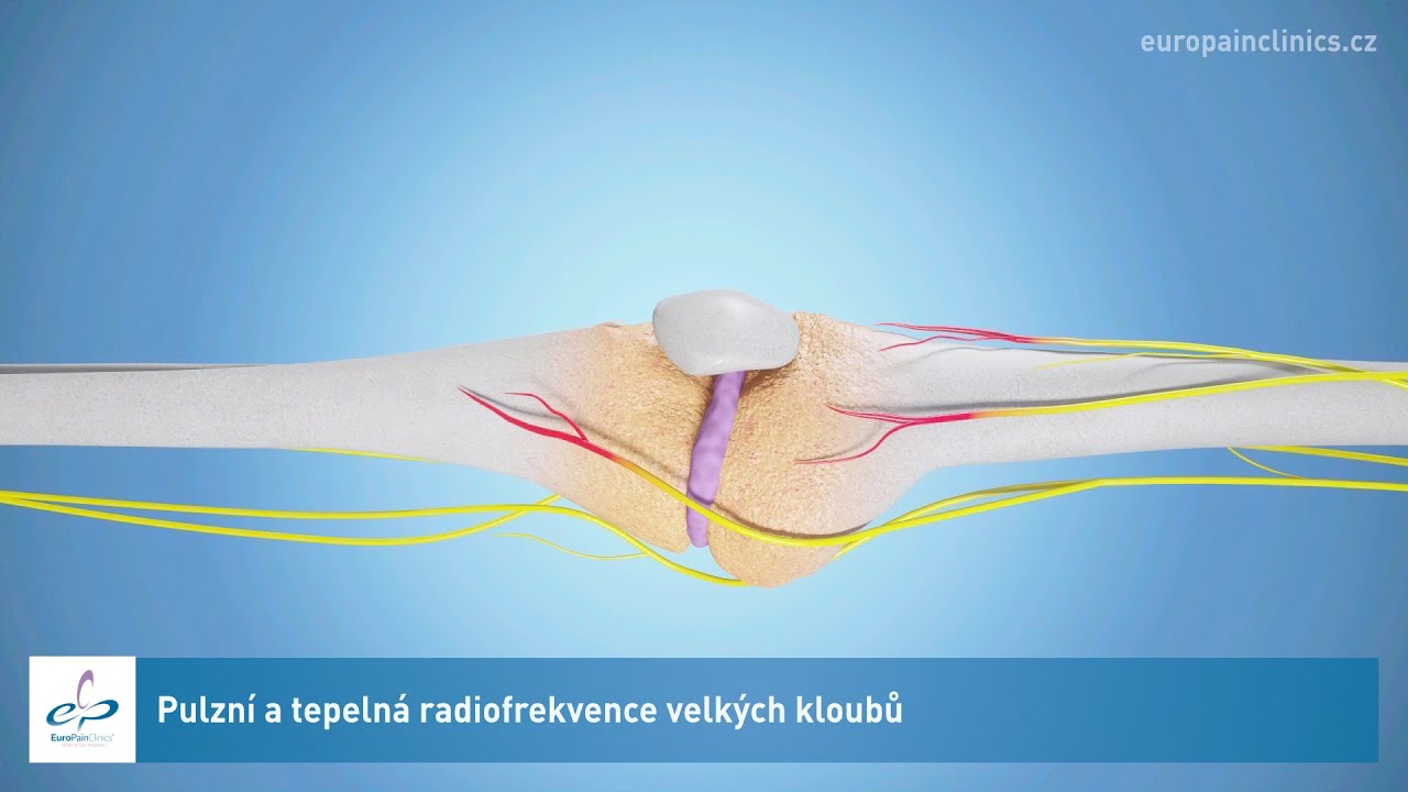 Pulzn&iacute; a tepeln&aacute; radiofrekvence velk&yacute;ch kloubů