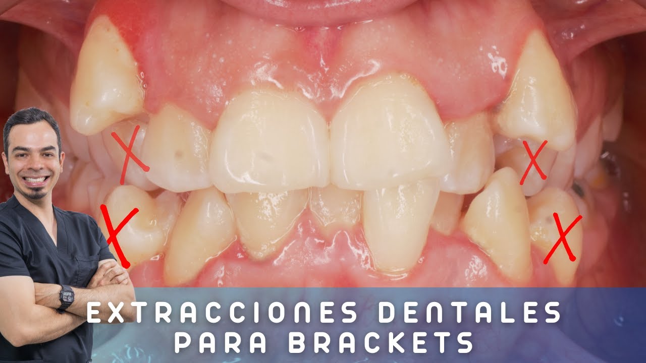 ¿EXTRACCIONES DENTALES para poner BRACKETS SON NECESARIAS?