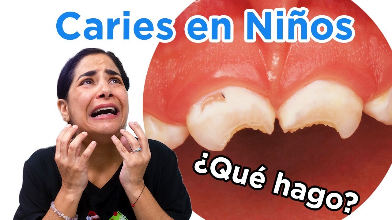 Caries en beb&eacute;s | &iquest;C&oacute;mo se ven? &iquest;C&oacute;mo se previene?