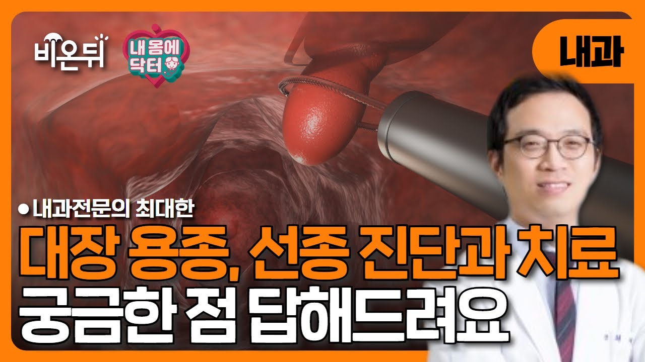 [내몸에닥터] 용종과 선종 차이 알아보기/ 내과전문의 최대한