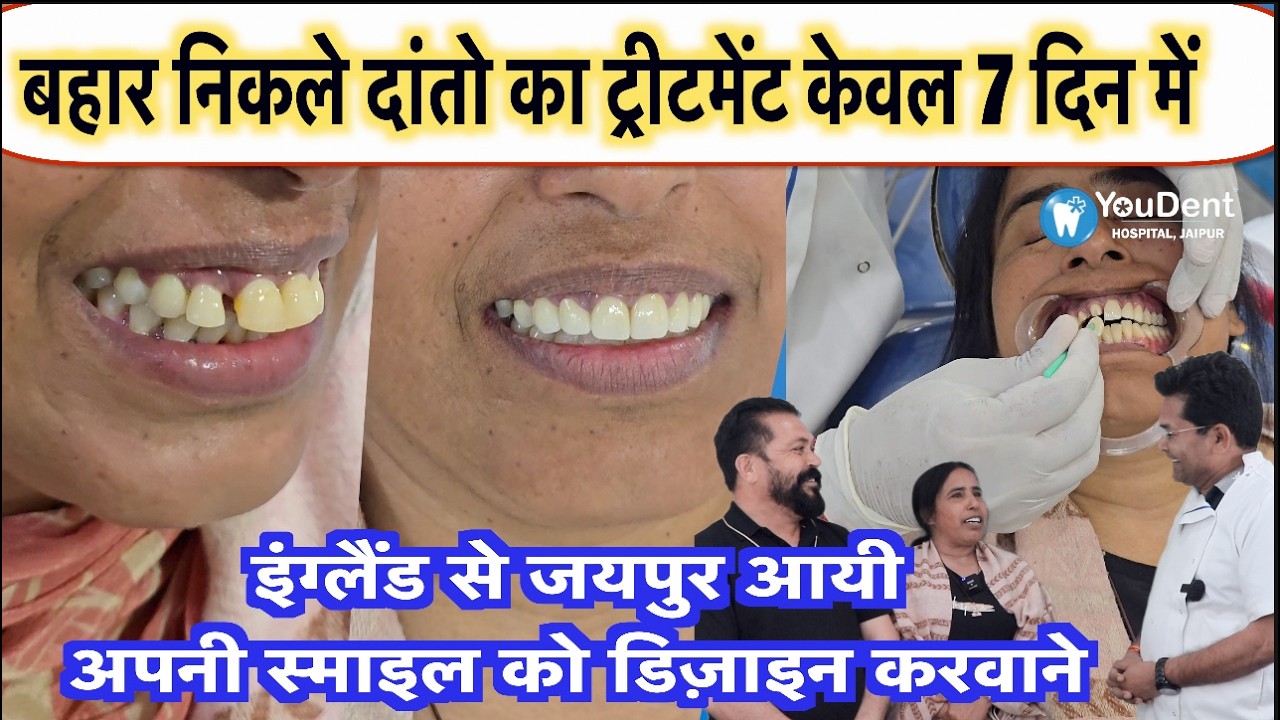 Smile Makeover in India |UK Patient Gap Teeth Fixed in 7 Days | No Extraction |Jaipur YouDent