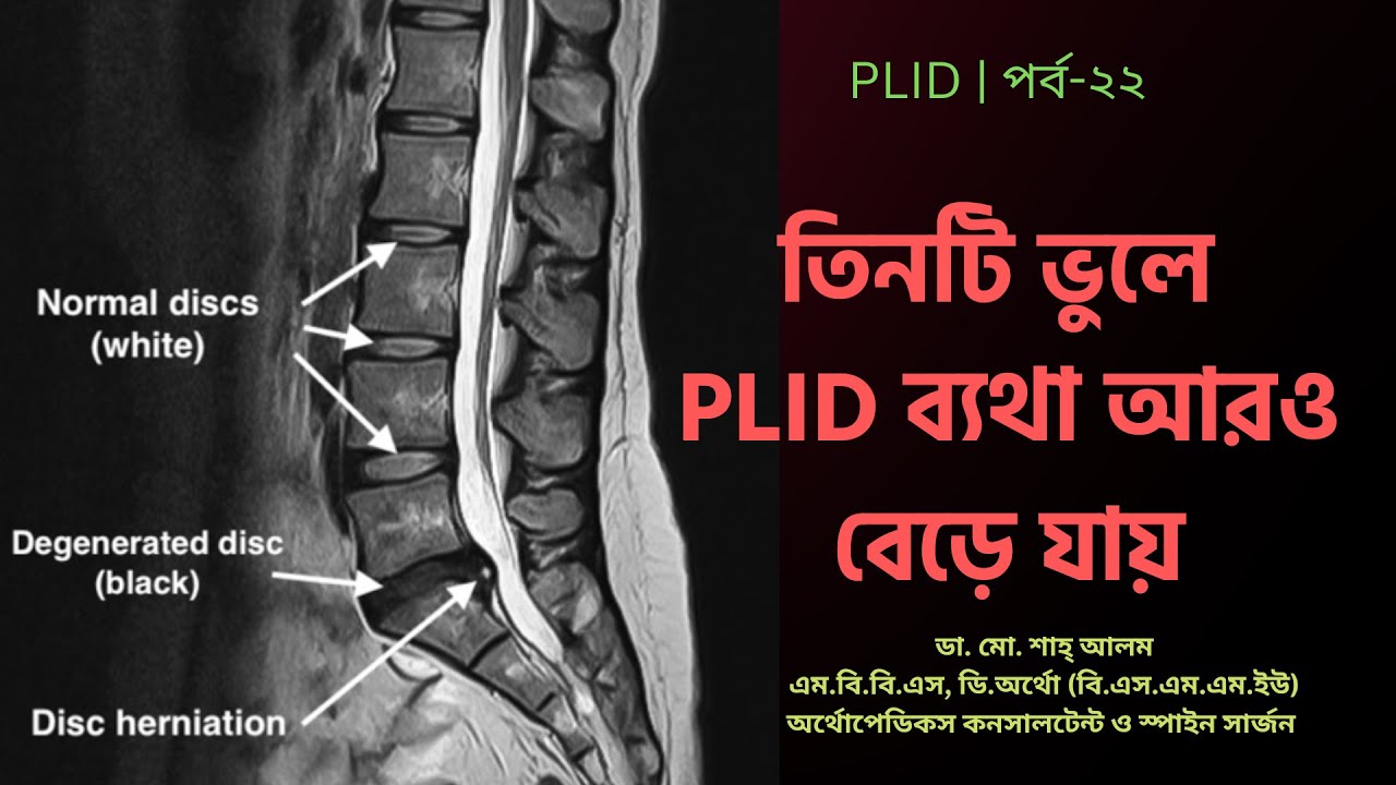 PLID 22 | তিনটি ভুলে PLID ব্যথা আরও বেড়ে যায় | 3 Mistakes More PLID Pain | Doctor Shah Alam