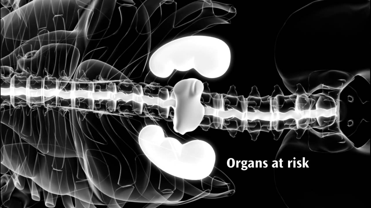 Elekta VMAT animation HD720P