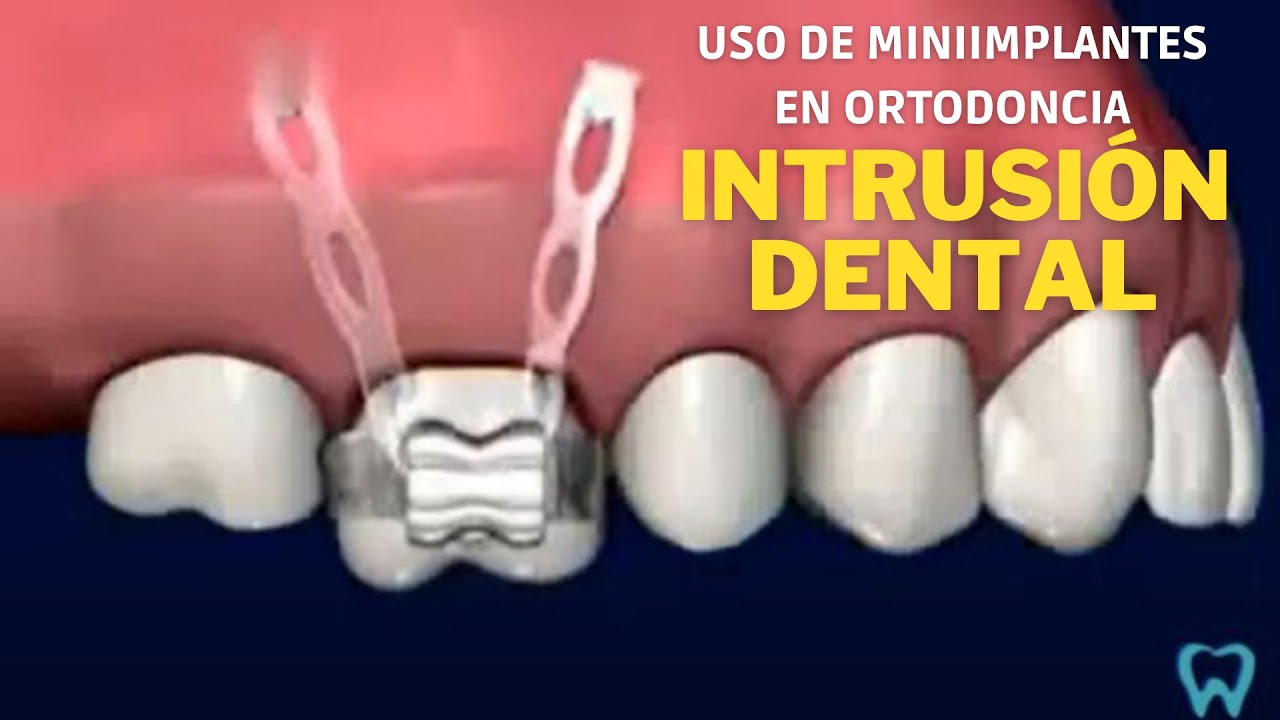INTRUSIÓN DENTAL con el uso de miniimplantes en Ortodoncia