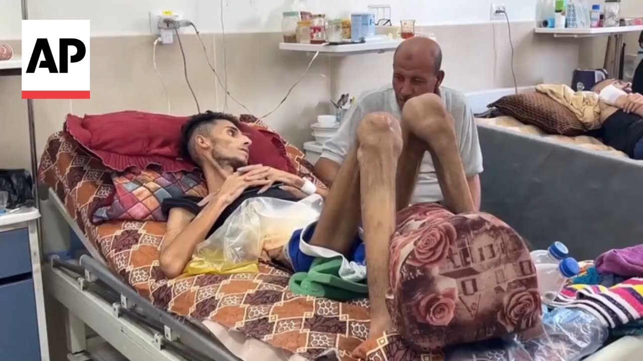 Doctors in Gaza say evidence of malnutrition is right in front of them
