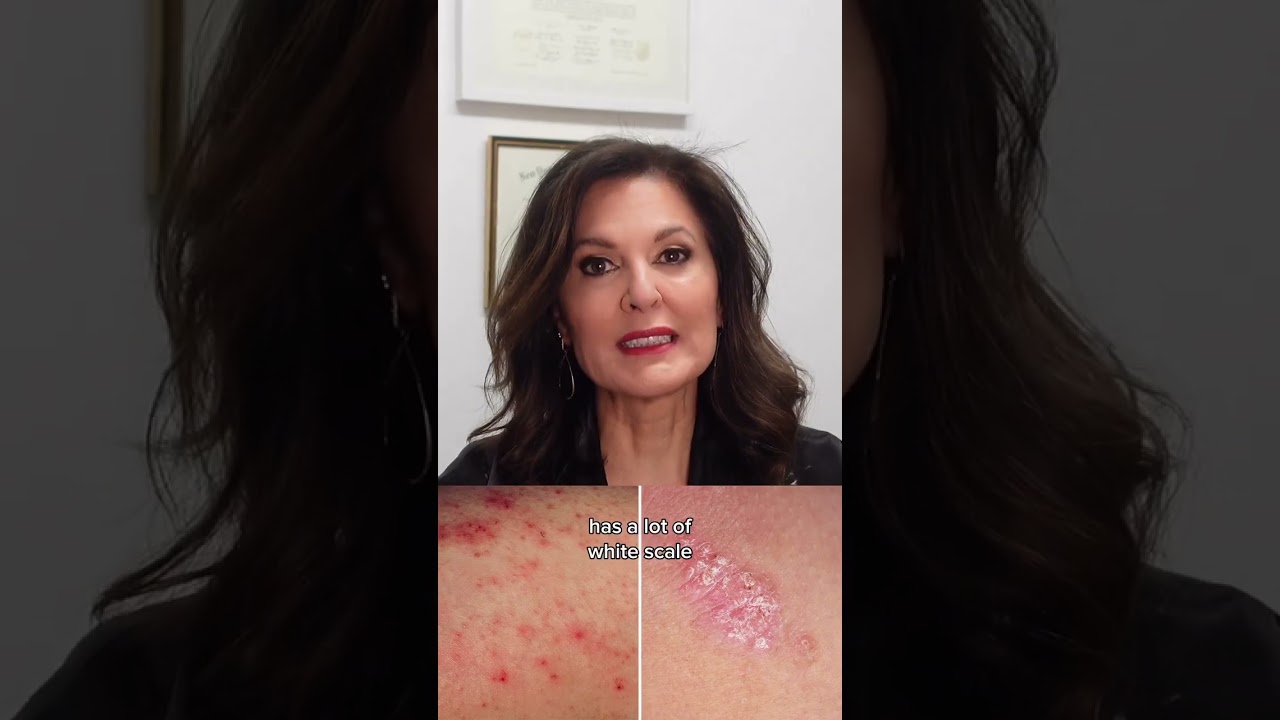 Is it eczema or psoriasis?