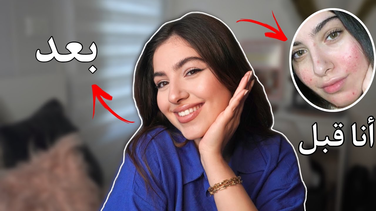 كيف تخلصت من حبوب الوجه! + اثار حب الشباب