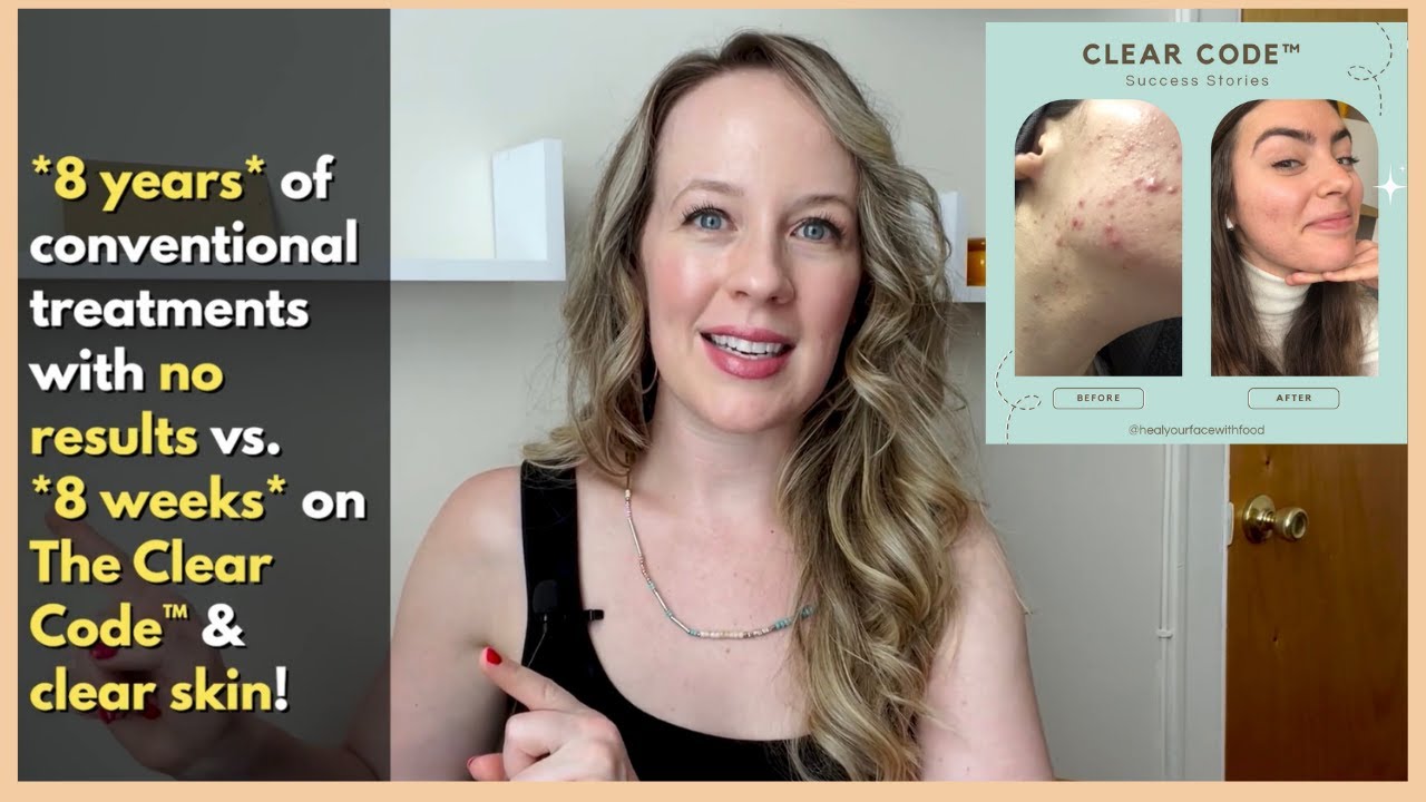 8 weeks to clear skin after 8 years of no results! Maria's journey on The Clear Code&trade;
