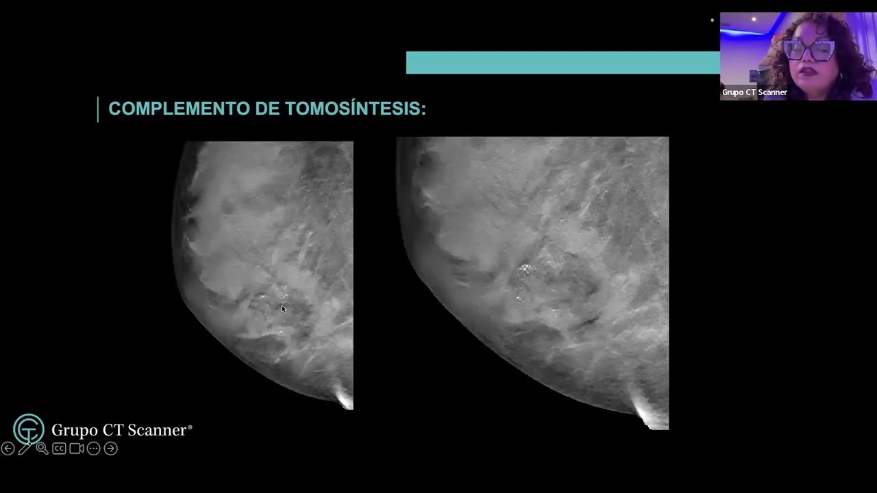 Sesión mensual de la Unidad e Imagen Mamaria, revisión de casos impartidos por CT Scanner México.
