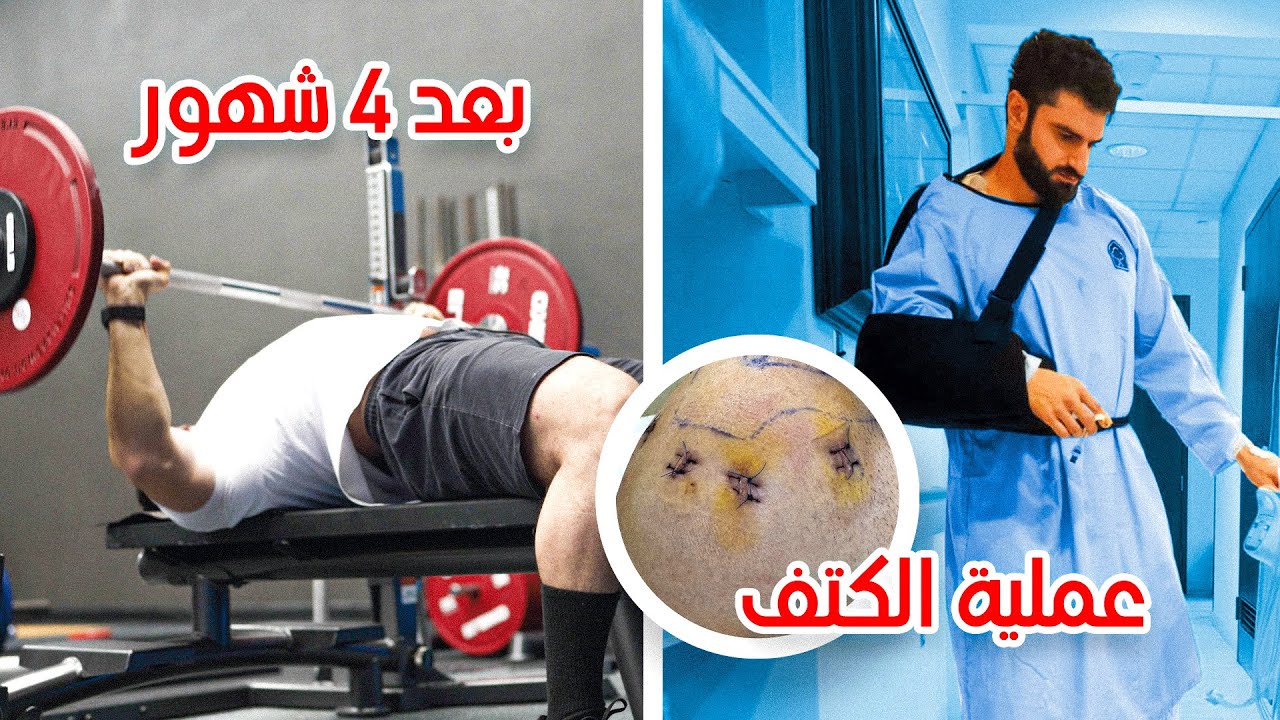 نصائح بعد عملية الكتف