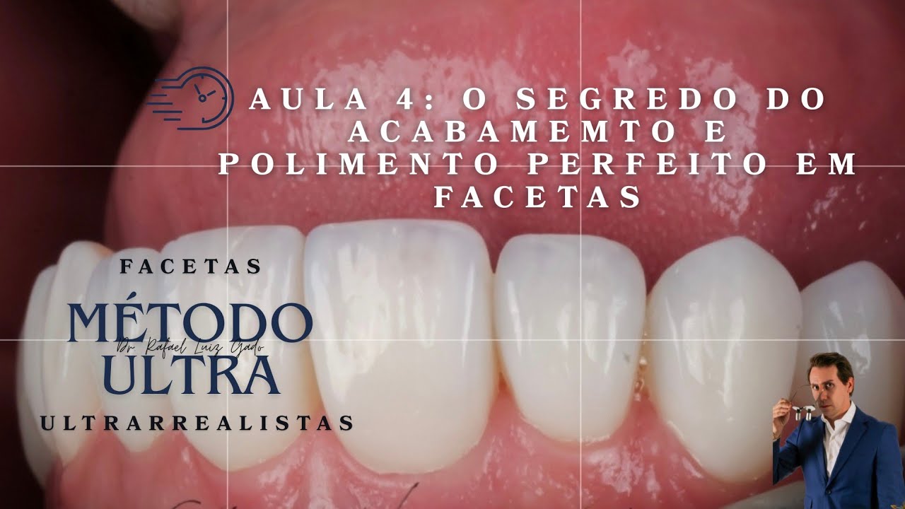 AULA 4: O Segredo do Acabamento Perfeito em Facetas que Ninguém Te Ensinou!🤩