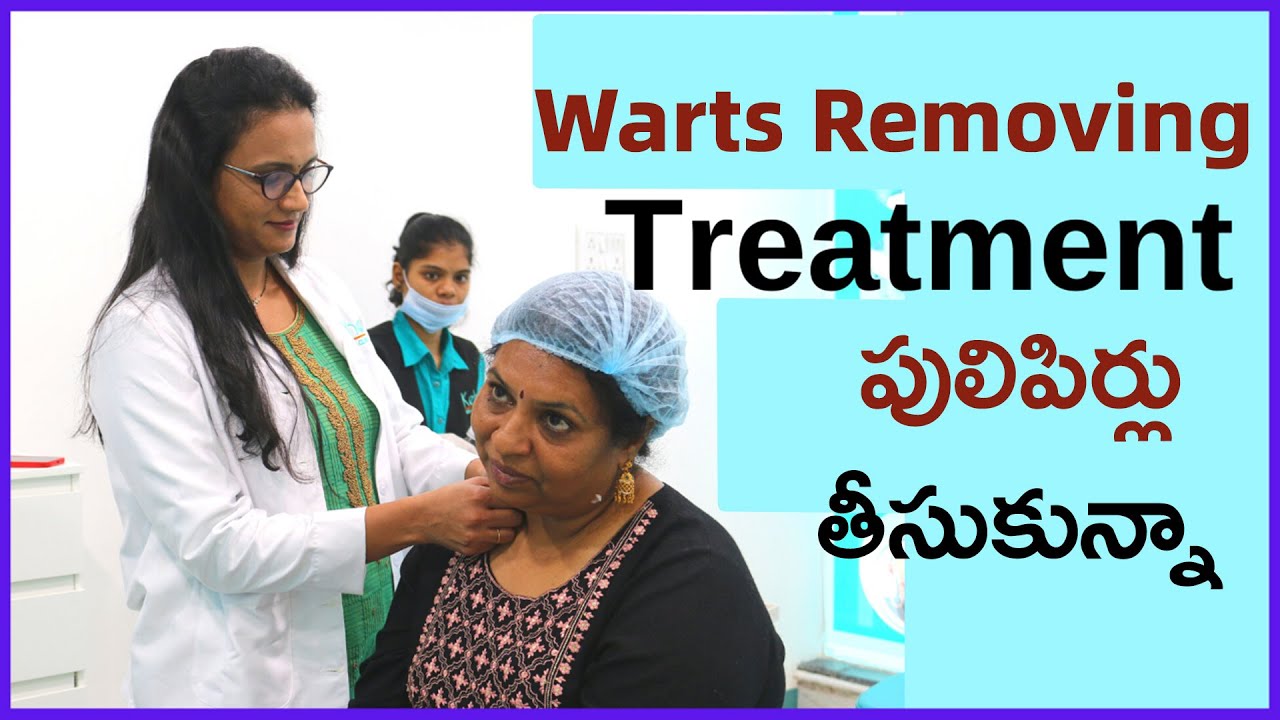 పులిపిర్లు ఇలా easy గా తీయించుకున్నాను/Get rid of Warts - A clinical solution