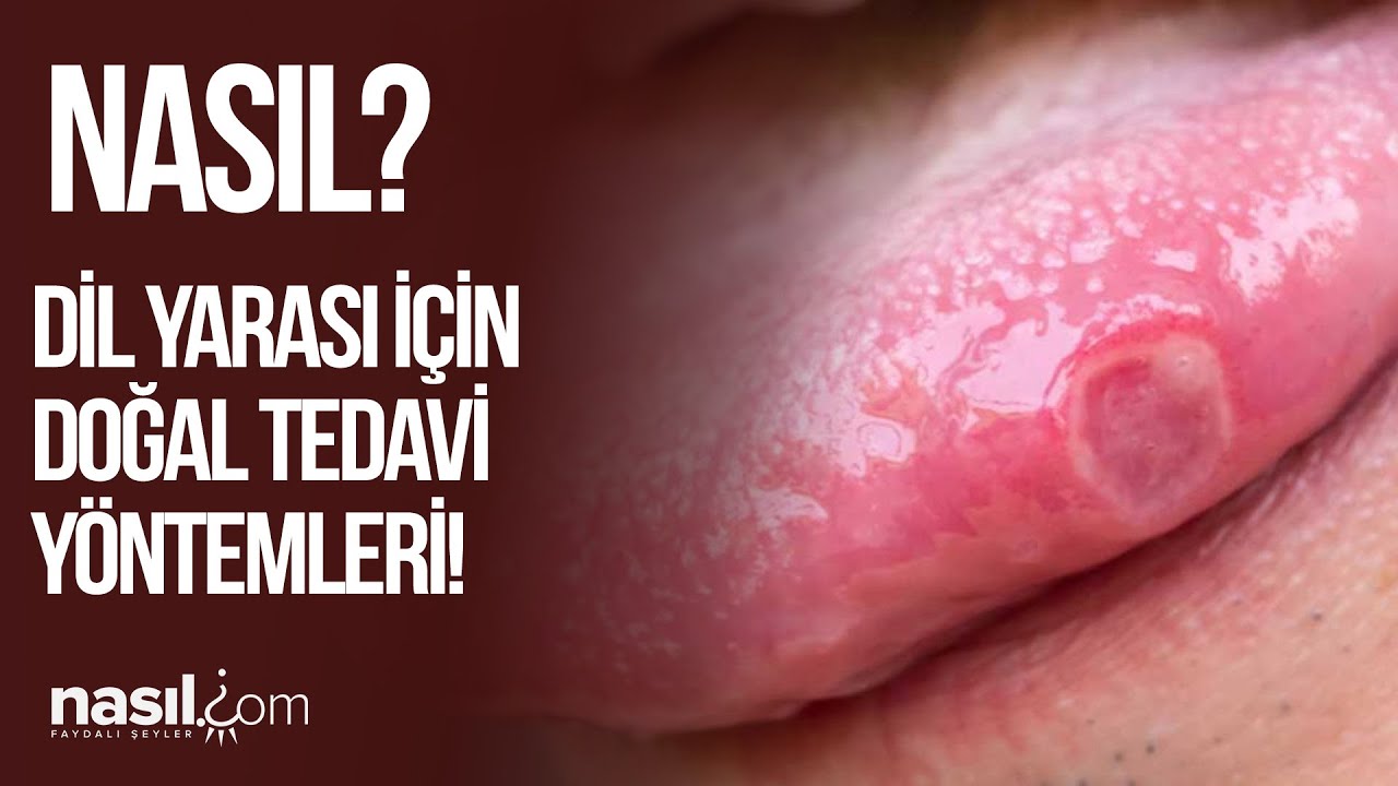 DİL YARASI NASIL GE&Ccedil;ER? NE İYİ GELİR? İŞTE DOĞAL &Ccedil;&Ouml;Z&Uuml;MLER! #dil #yara #sağlık #doğal #tedavi