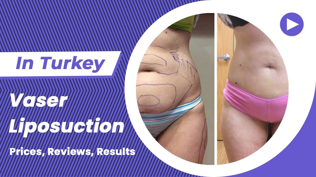 Liposuction in Turkey (Cost, Reviews, Results, Before, After) - Flora Clinic