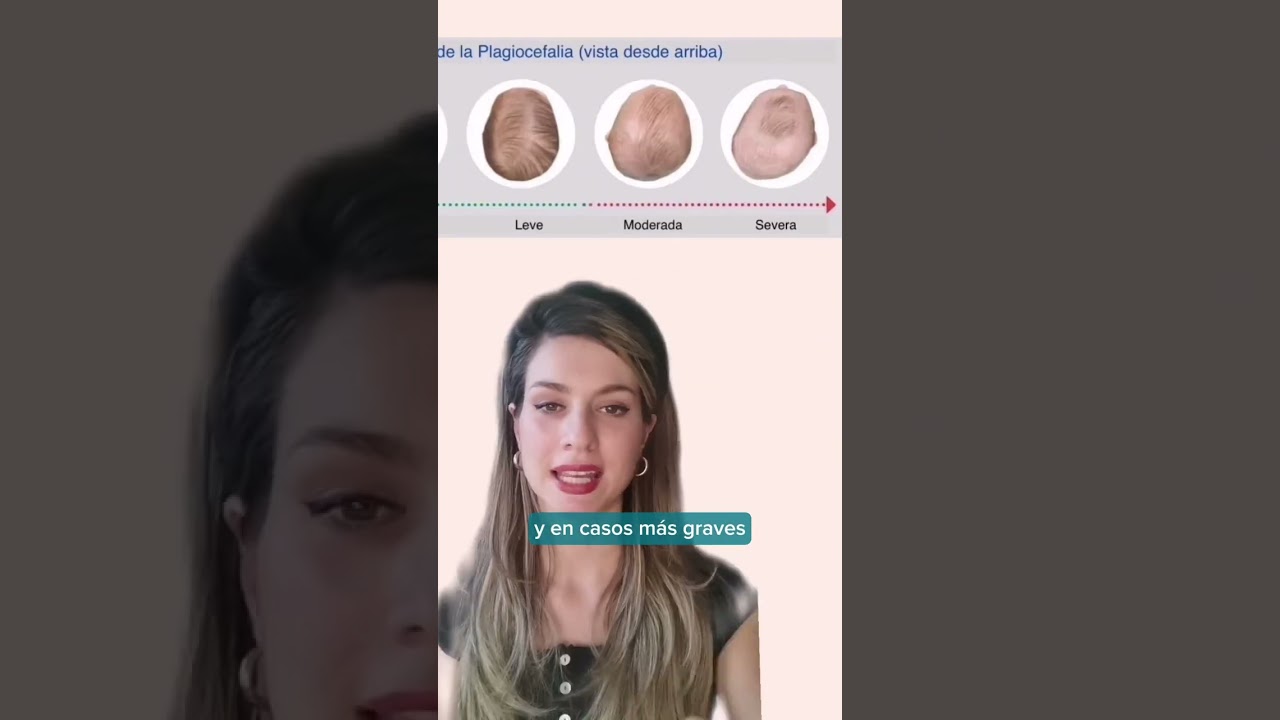 Evita la plagiocefalia en tu bebé recién nacido