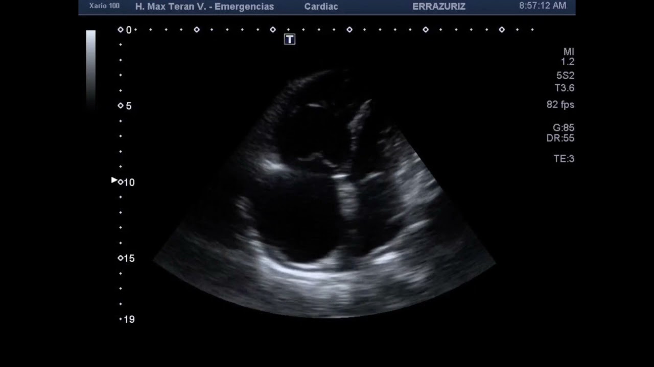 Caso 5 Hipertensión Arterial Pulmonar