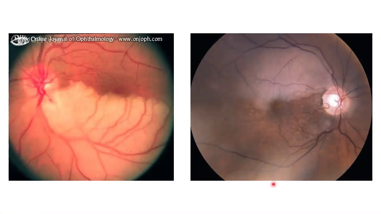 Oclusiones Arteriales Retinianas